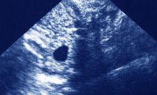 Costa Rica Therapeutic Abortion
